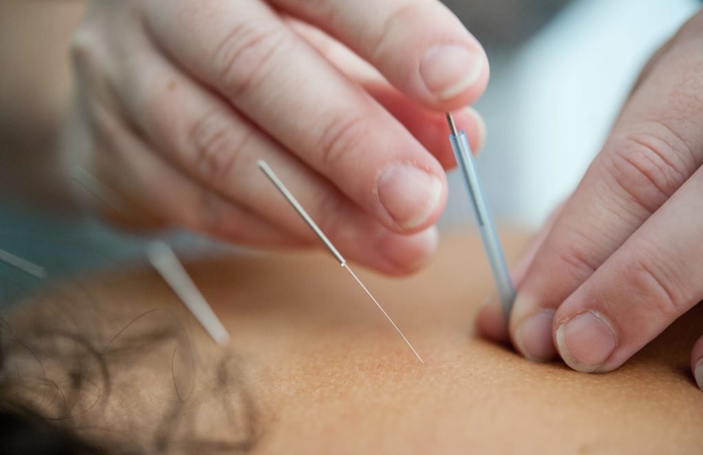 acupuncturist performing acupuncture 